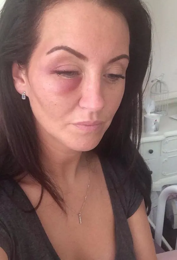 Riona Kelly with visible bruising to her eye
